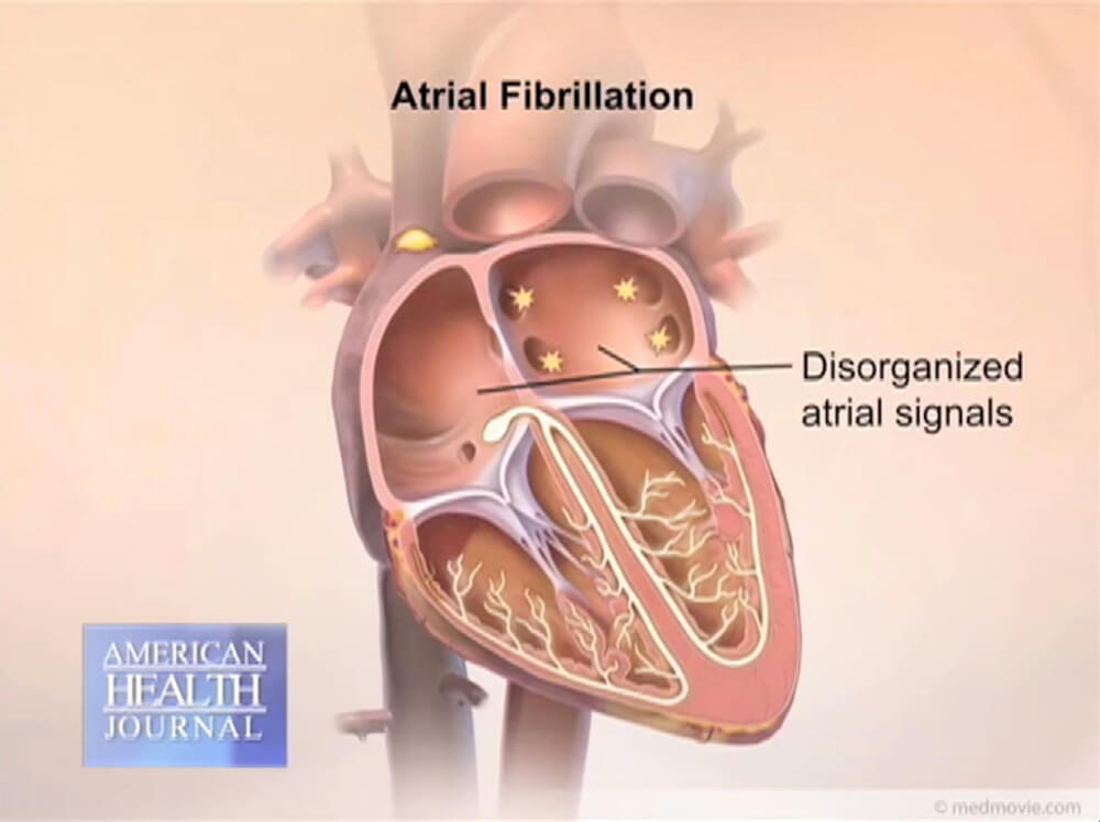 Diagram of Atrial Fibrillation Disorganized Atrial Signals