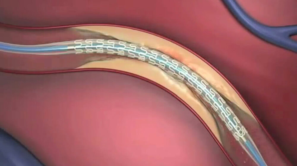 Stent Placed Inside Artery