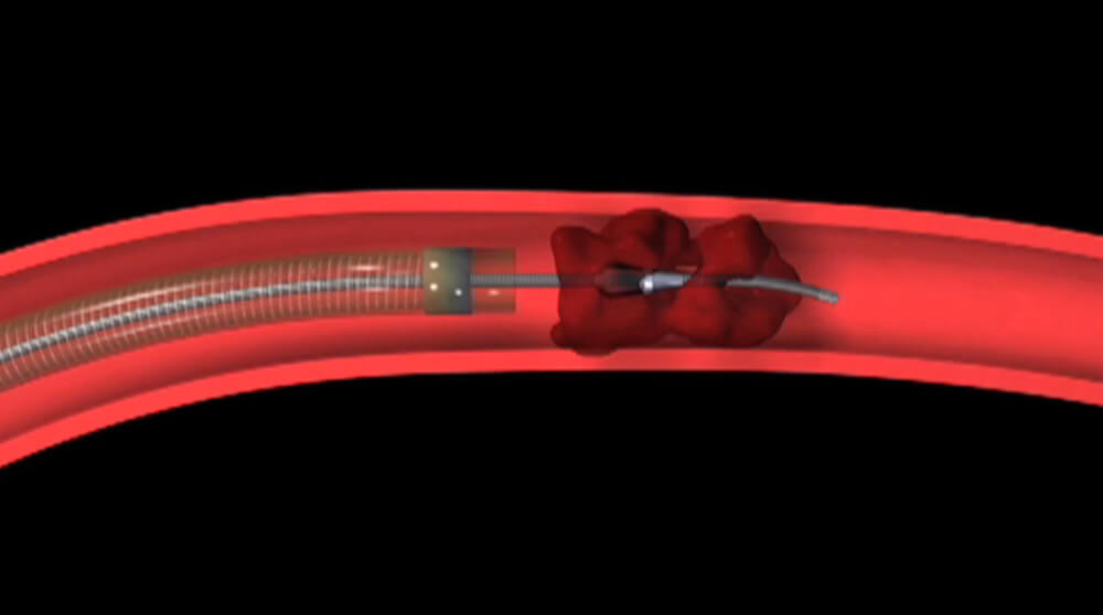 Catheter Tube Inserted into a Clot Delivering