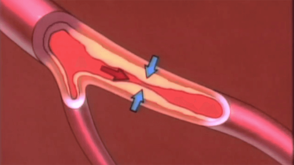 Blockage in Artery