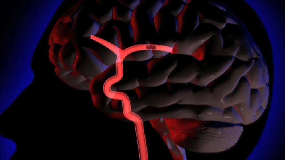 Diagram of Ischemic Stroke Blockage in Brain