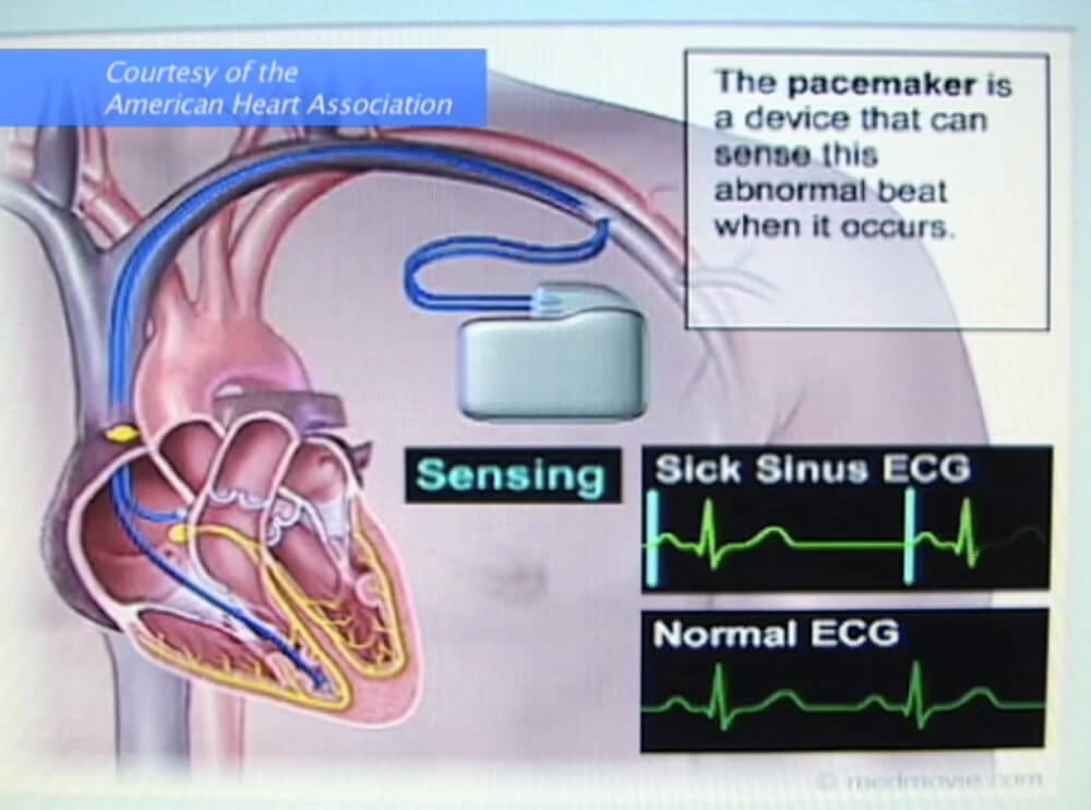 Diagram of Pacemaker Sensing Abnormal Heartrate