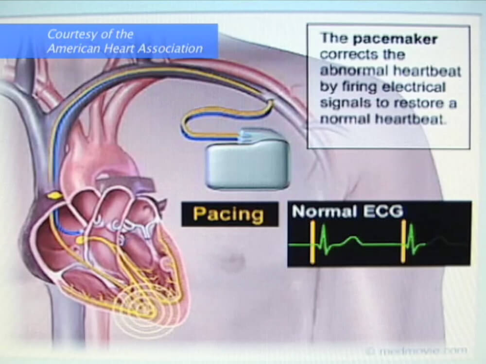11 Diagram Of Pacemaker Correcting Abnormal Heartrate