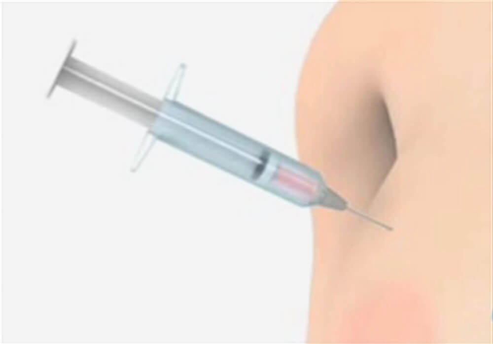 Stereotactic Needle Biopsy of Breast Part