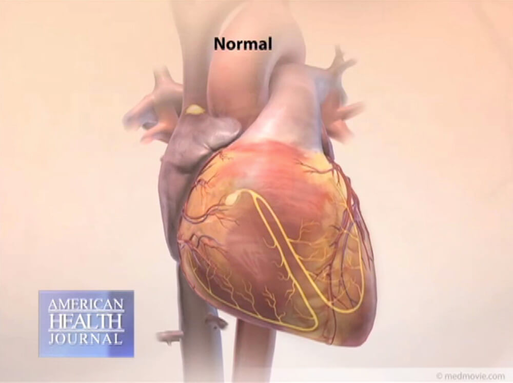3 Diagram Of Normal Heart Exterior