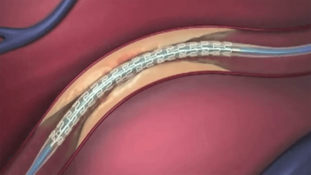 Stent Placed in Artery