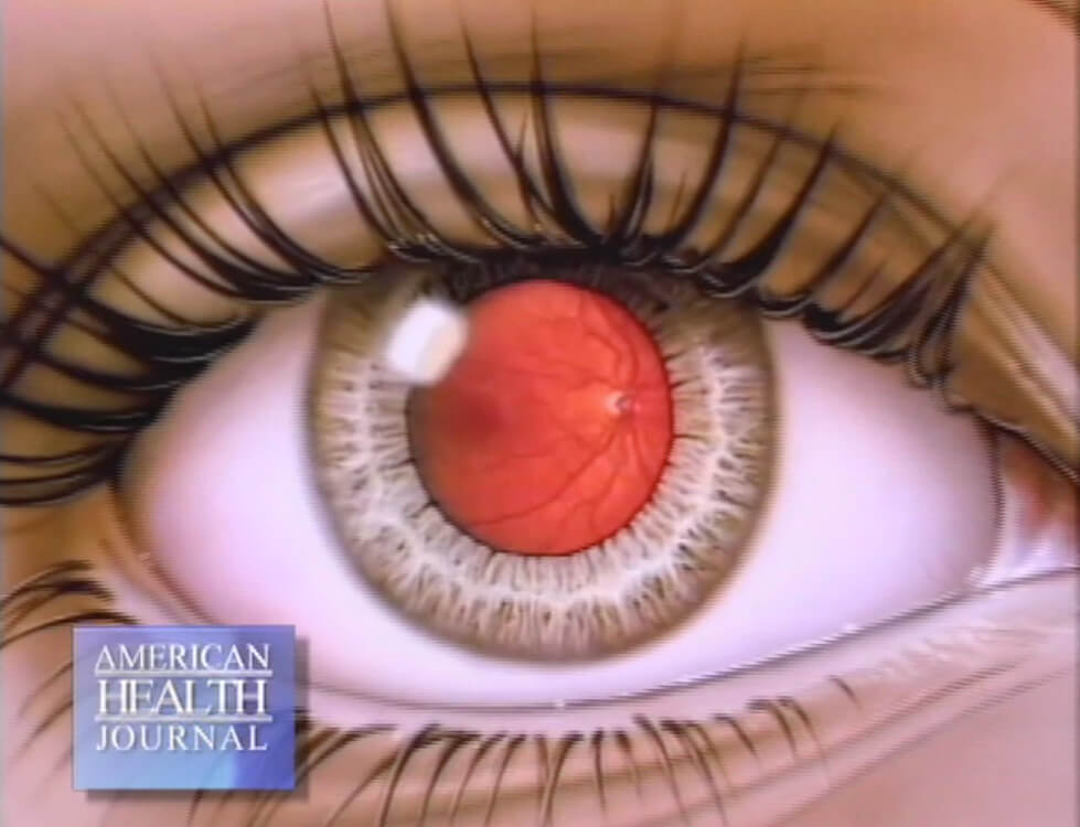Damage to the Eye Retina from Diabetes