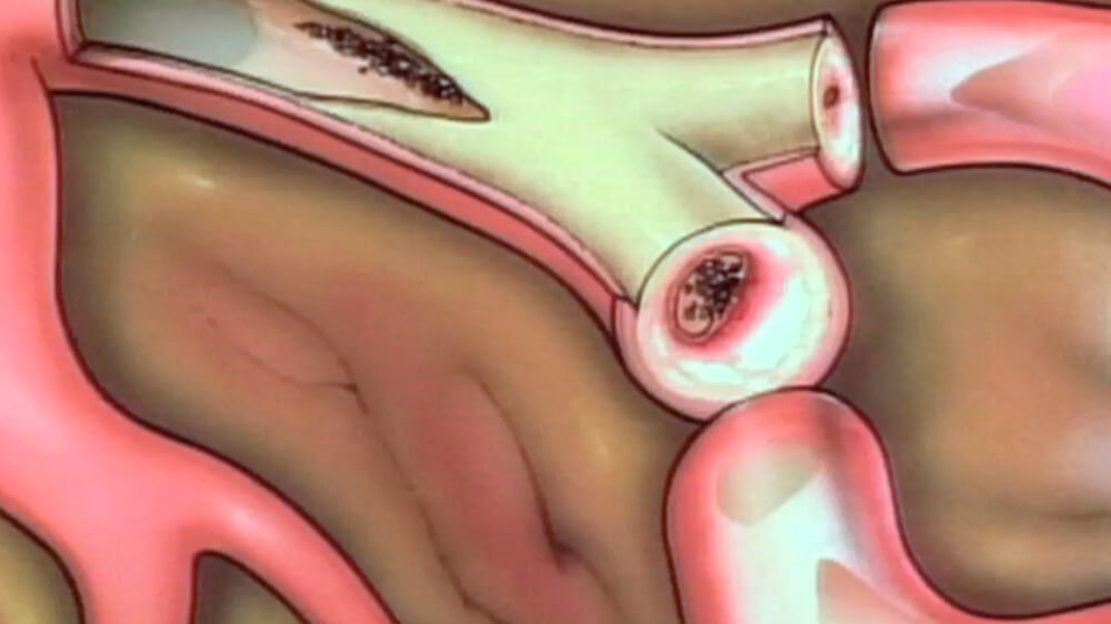 5 Complete Blockage Of Blood In Artery 1)