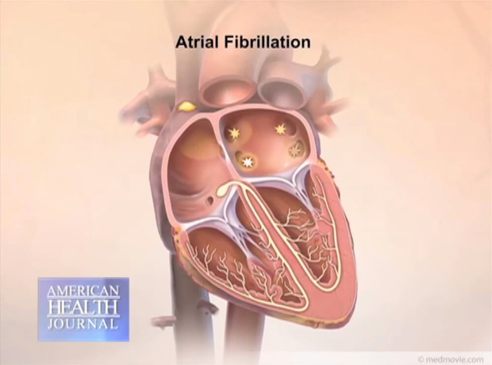 Atrial Fibrillation