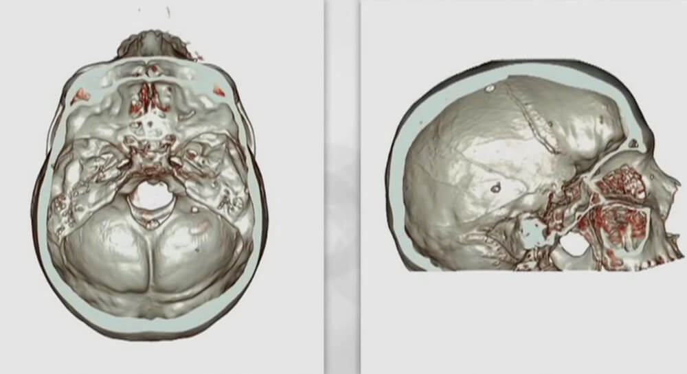 Split Screen Illustration of Normal Brain