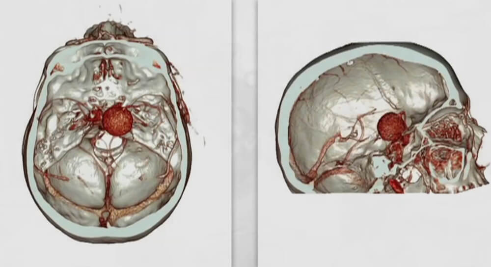 Split Screen Illustration of Hemorrhagic Stroke