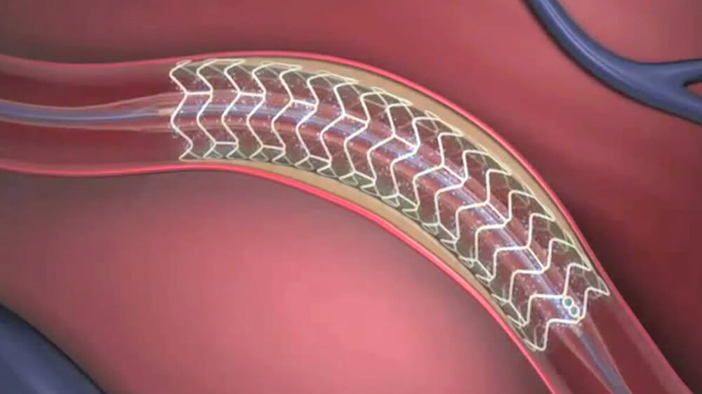 Blood Flowing Throw Stent in Artery