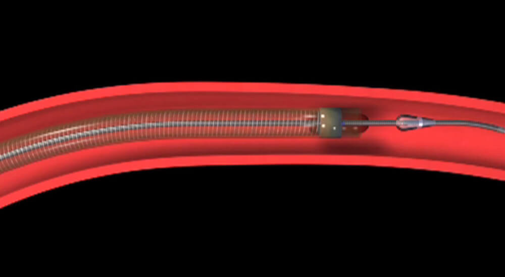 Catheter Tube Encasing Clot and Pulling it Out